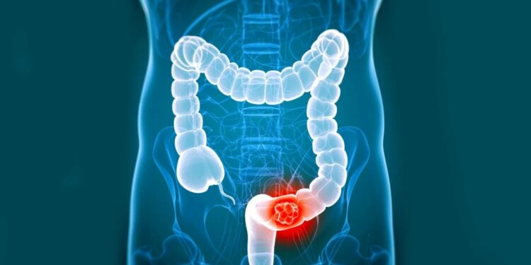 कोलोरेक्टल कैंसर के 5 चेतावनी संकेत और लक्षण, जानिए कैसे करें खुद को सुरक्षित