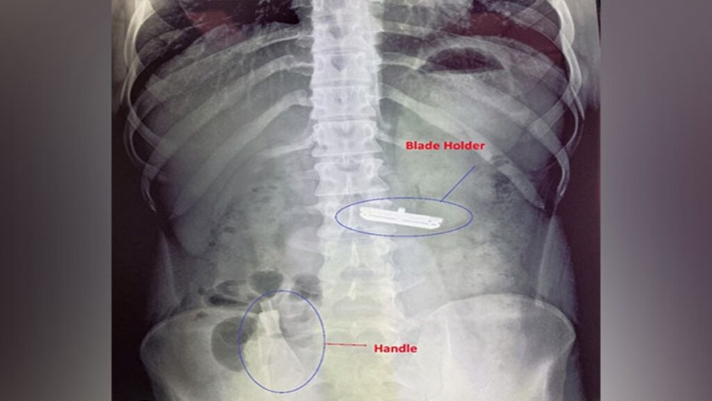 विचित्र! दिल्ली के सर गंगा राम अस्पताल में डॉक्टरों ने एक शख्स के पेट से शेविंग रेजर निकाला