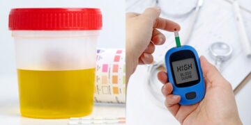 मधुमेह मूत्र के लक्षण: फोम के मूत्र के लिए लगातार पेशाब, 5 संकेतों के लिए बाहर देखने के लिए