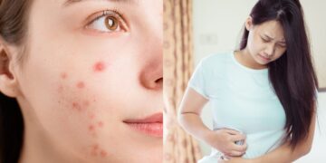 पाचन समस्याओं के लिए मुँहासे: उच्च तनाव के स्तर के असामान्य संकेत जिन्हें आपको ध्यान देना चाहिए