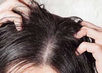 डैंड्रफ से छुटकारा पाने के लिए घर पर इस आयुर्वेदिक हेयर मास्क की कोशिश करें, लाभ जानें