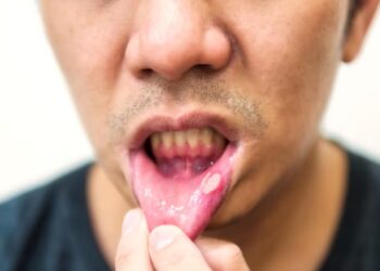 हार्मोनल परिवर्तन के लिए मौखिक स्वच्छता: मुंह के अल्सर के 6 प्रमुख कारणों को पता होना चाहिए