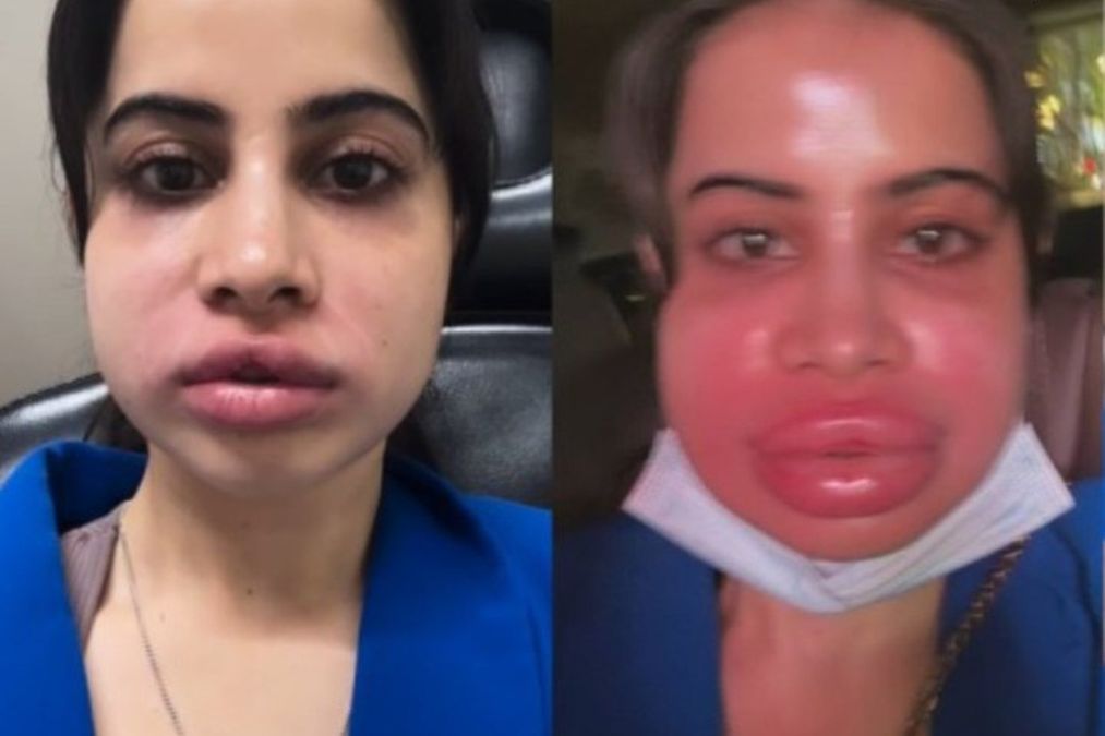 Urfi Javed 9 साल के बाद लिप फिलर्स को हटा देता है, Swellen-Lip वीडियो पोस्ट-ट्रीटमेंट शेयर करता है